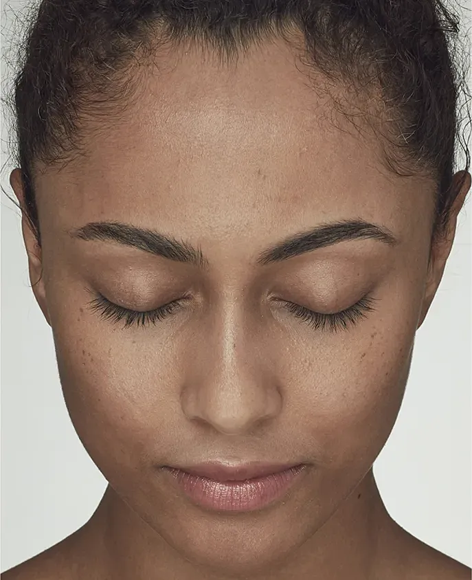 Latisse Before & After