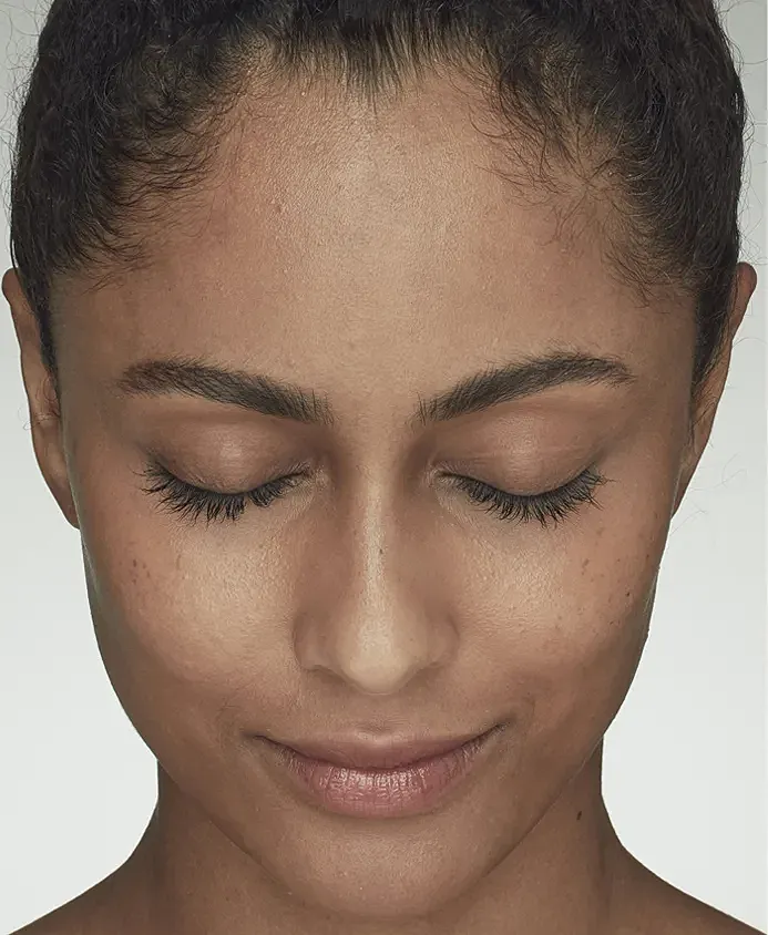 Latisse Before & After